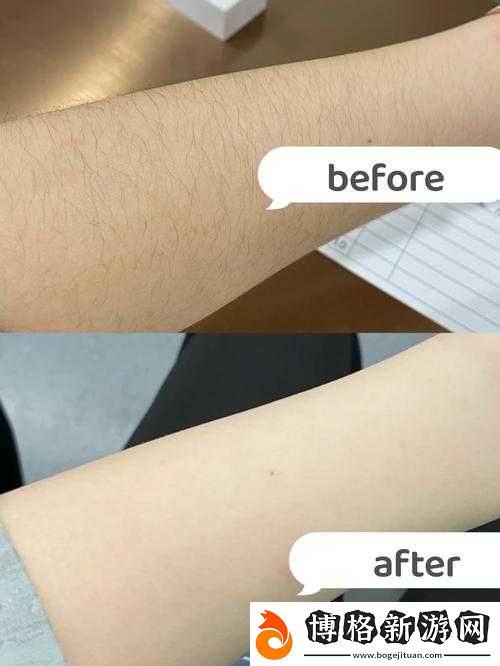 未滿十八歲可以激光脫毛嗎女生:探索青春期脫毛的可行性